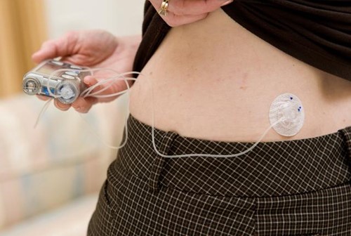 Insulin Pump